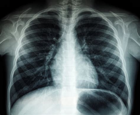 Rentgeno nuotrauka su pavaizduotu pneumotoraksu