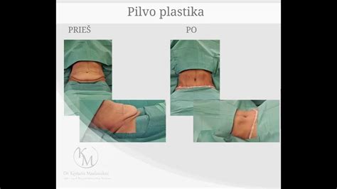 Medicininė schema, iliustruojanti pilvo plastikos indikacijas