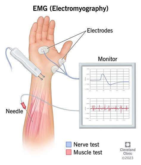 Infografikas, vaizduojantis nervų impulsų sklidimą ir EMG tyrimo metu naudojamus elektrodus ant paciento rankos