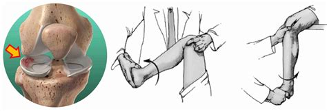 atliekamas McMurray testas