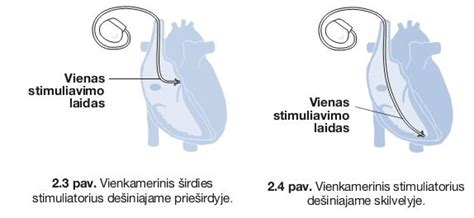 Infografika, lyginanti skirtingų tipų širdies stimuliatorius