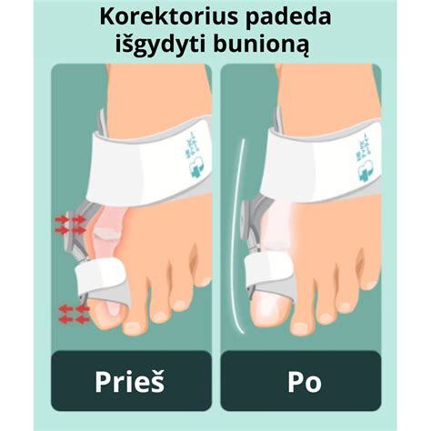 pėdos tipų (normali, plokščia, aukšta skliauto) vizualizacija