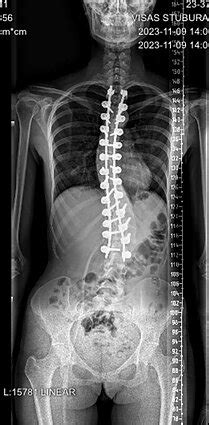 Nuotrauka, vaizduojanti Halo aparatą, naudojamą stuburo traumoms gydyti