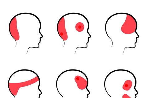 iliustracija, rodanti skirtingus būdus, kaip nuimti galvos atramas
