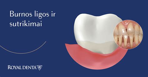 schema su dažniausiomis burnos opų atsiradimo priežastimis