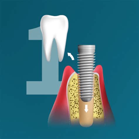 Infografika: Dantų implantacijos etapai ir panaudotos technologijos