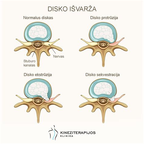 Schema: stuburo slankstelių anatomija ir disko išvarža