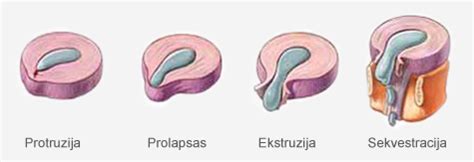 infografika, vaizduojanti skirtumus tarp stuburo disko išvaržos sukeliamo skausmo ir kriaušinio raumens sindromo
